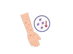Porpora trombocitopenica immunologica (ITP): sintomi, diagnosi e terapie