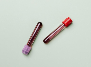 Esami del sangue: sapere leggere e comprendere i risultati di un test di funzionalità epatica