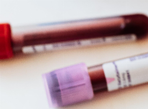 Lupus eritematoso sistemico: come leggere correttamente gli esami del sangue?