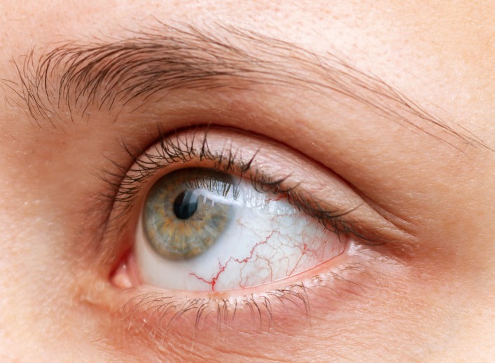 Quale legame c’è tra la malattia infiammatoria cronica intestinale (IBD) e i disturbi oculari?