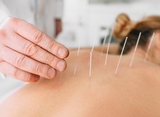 Agopuntura: come funziona e quando usarla? 