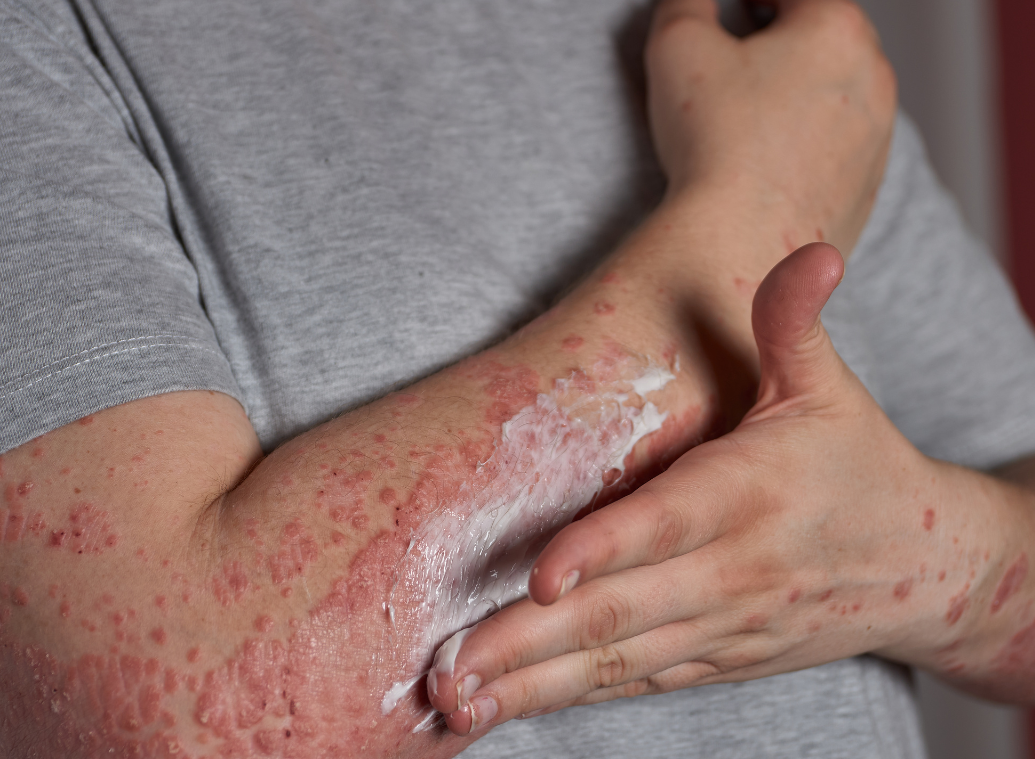 «La mia psoriasi non è mai riuscita a ottenere il visto per entrare nella mia testa»: la testimonianza di Phildu